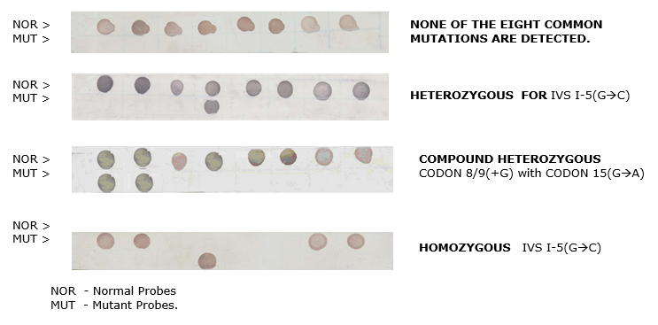 Beta Thalassemia